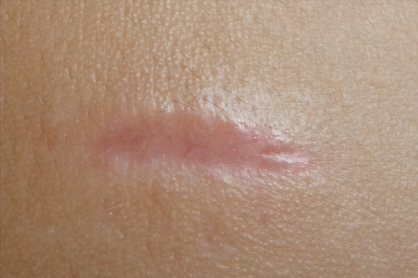 疤痕增生如何消除 皮肤增生能自愈吗