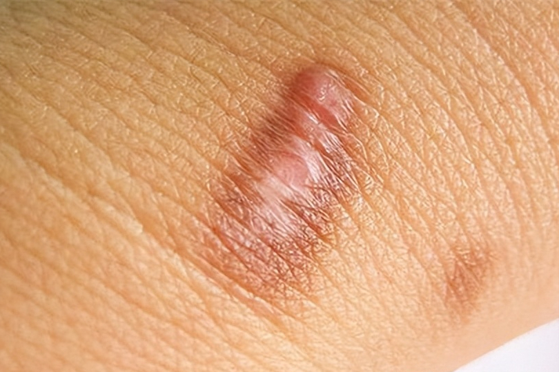 疤痕增生如何消除 皮肤增生能自愈吗