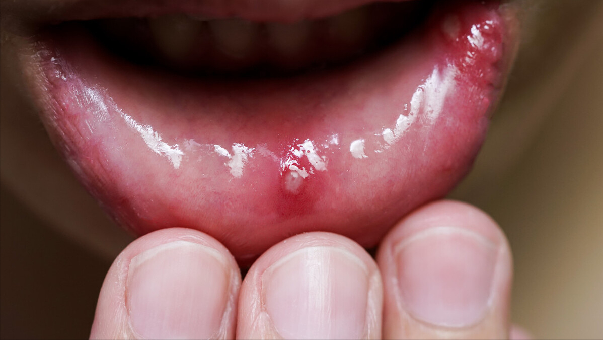 口腔溃疡怎么办最快最有效的方法 嘴里起口腔溃疡怎么治疗