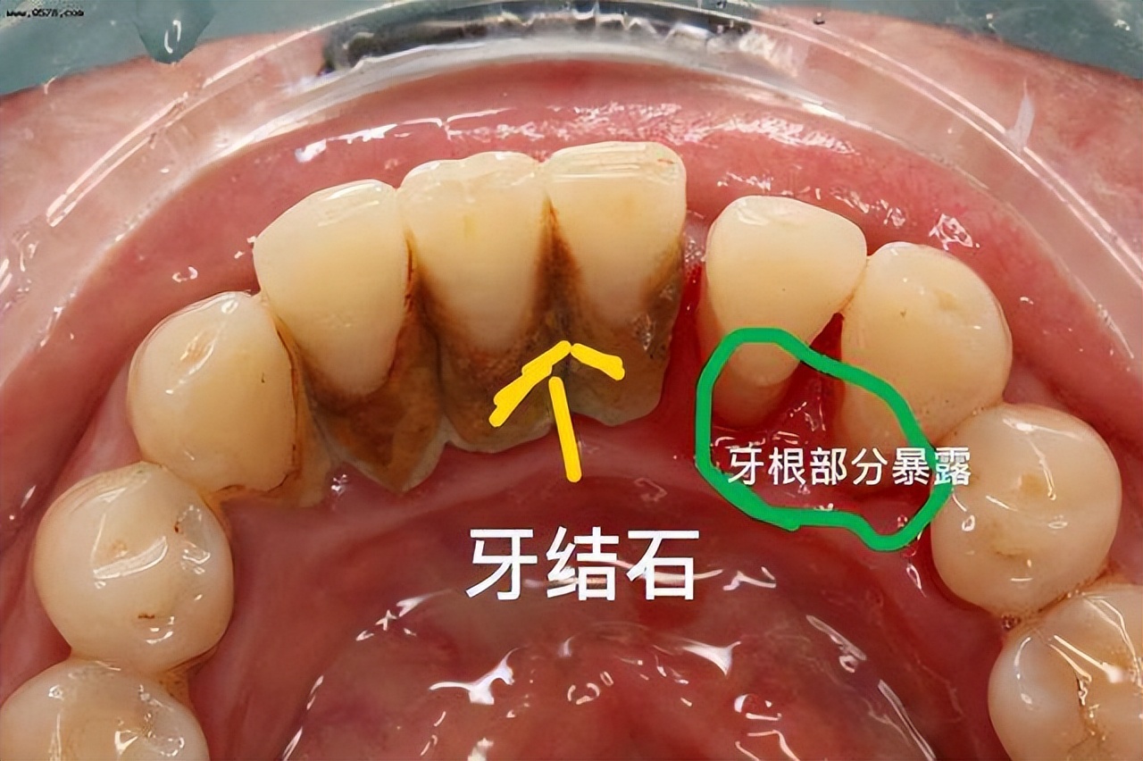 洗牙一次大概多少钱 洗牙大概多长时间