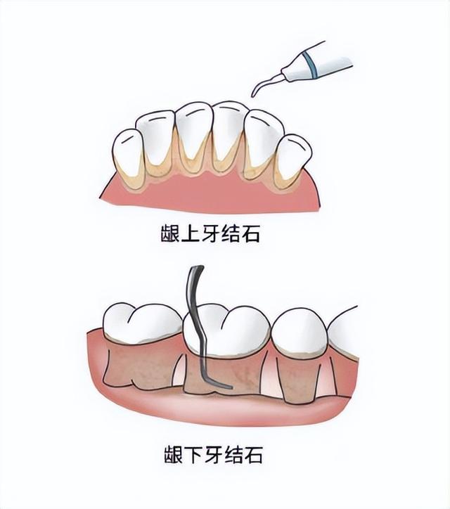 洗牙一次大概多少钱 洗牙大概多长时间