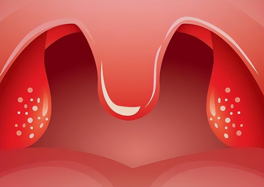 扁桃体发炎最快治疗方法 扁桃体炎自愈要几天