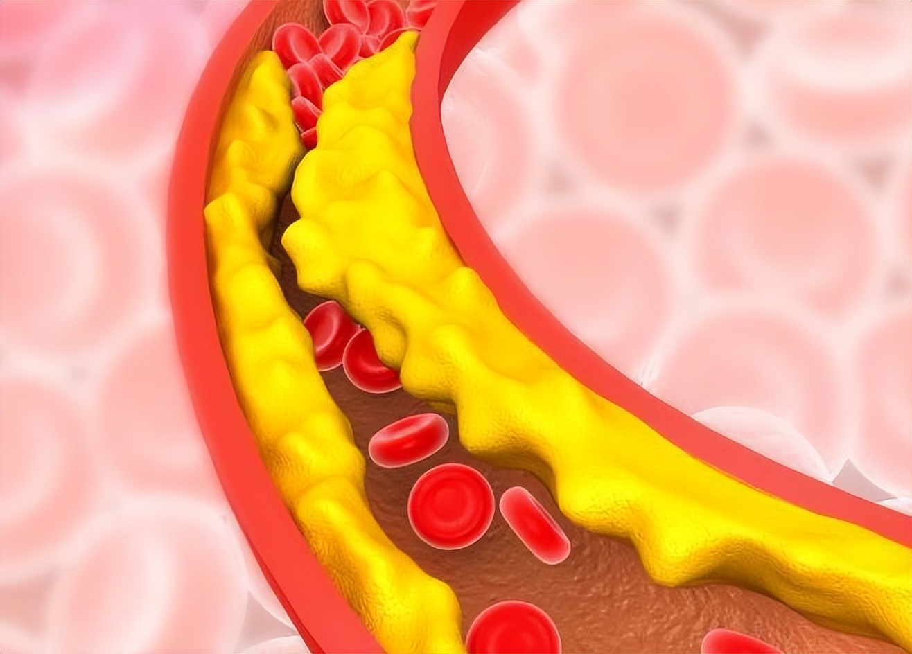 低密度脂蛋白偏高是什么意思 低密度高怎么降下来
