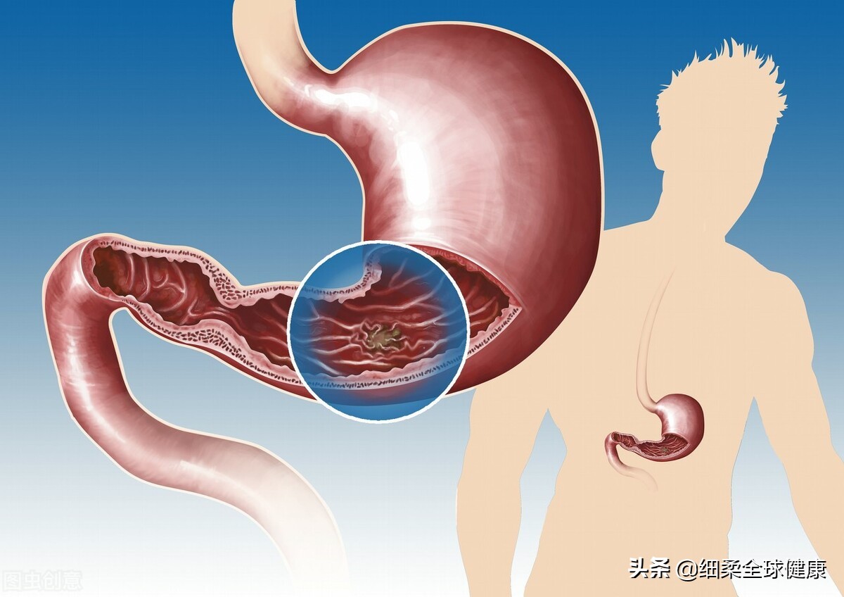胃溃疡症状表现有哪些 胃溃疡怎么治疗