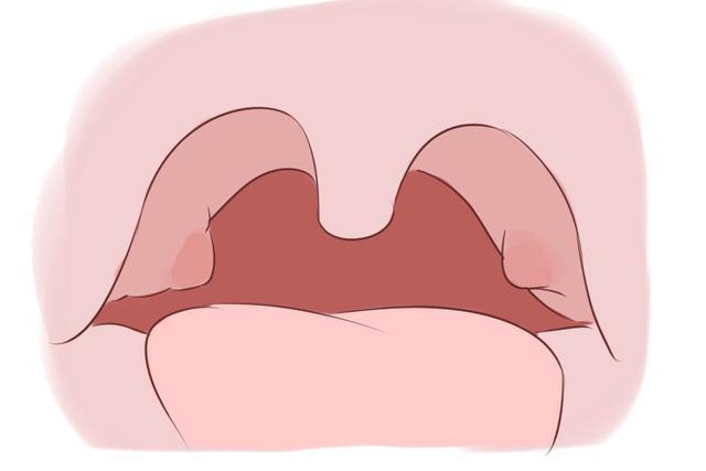 腮腺炎的症状 腮腺炎症状图片图