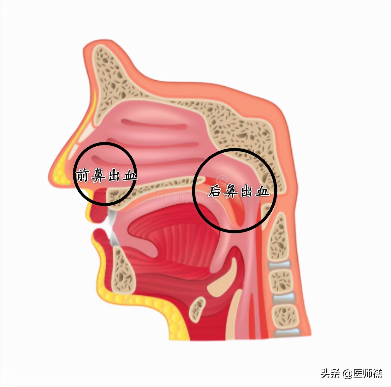 流鼻血是什么原因引起的呢? 单侧流鼻血是怎么回事