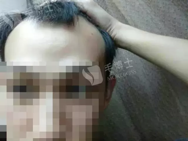 头发稀少如何加密 头发稀少多久能养回来