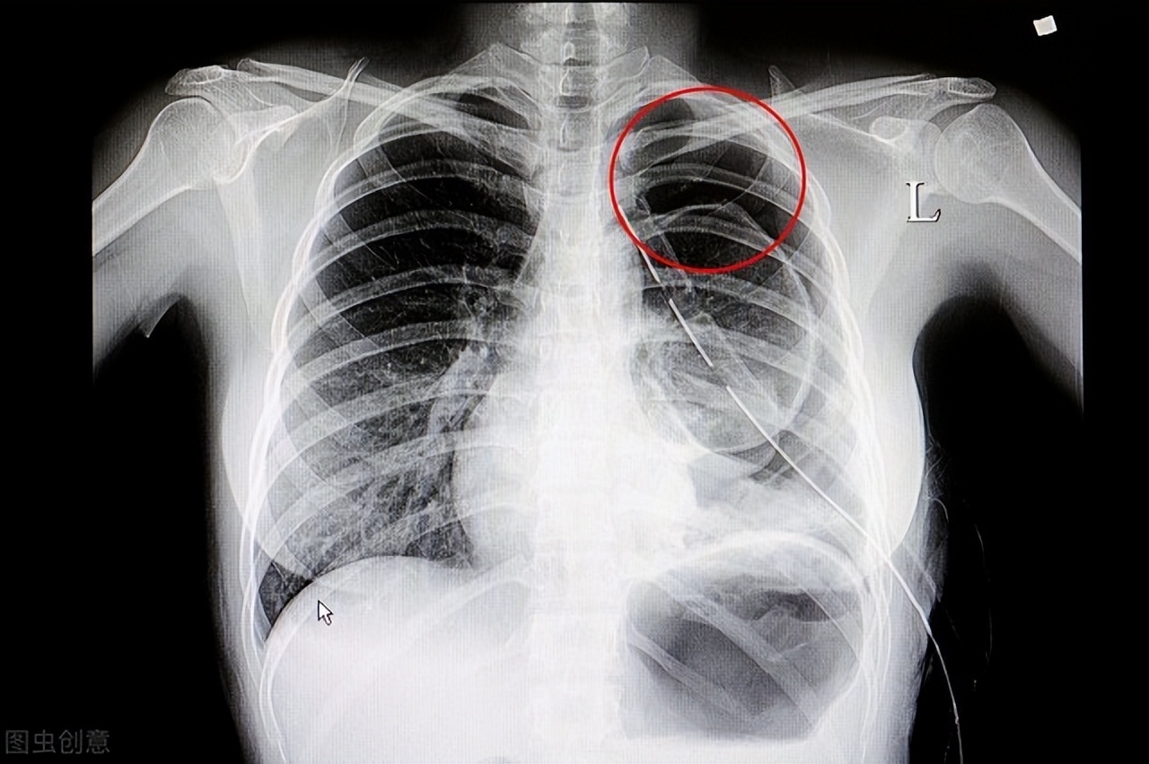 气胸是什么症状 气胸怎么治疗比较好