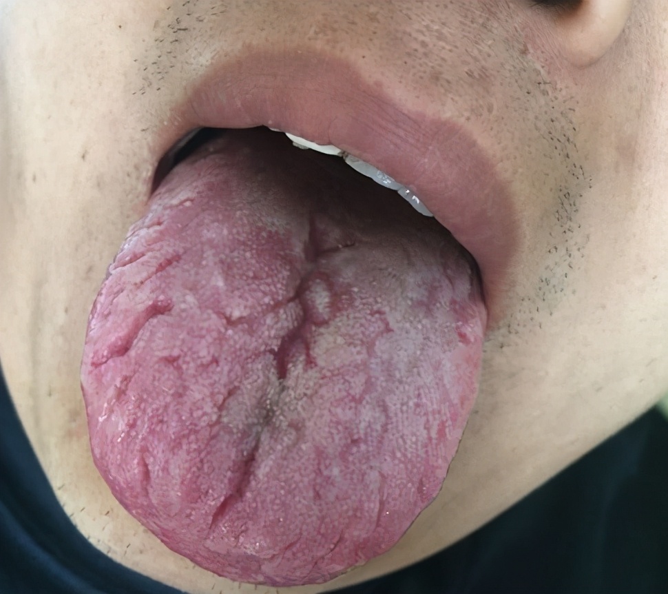 舌头发麻是什么原因 舌头发麻吃什么药最有效