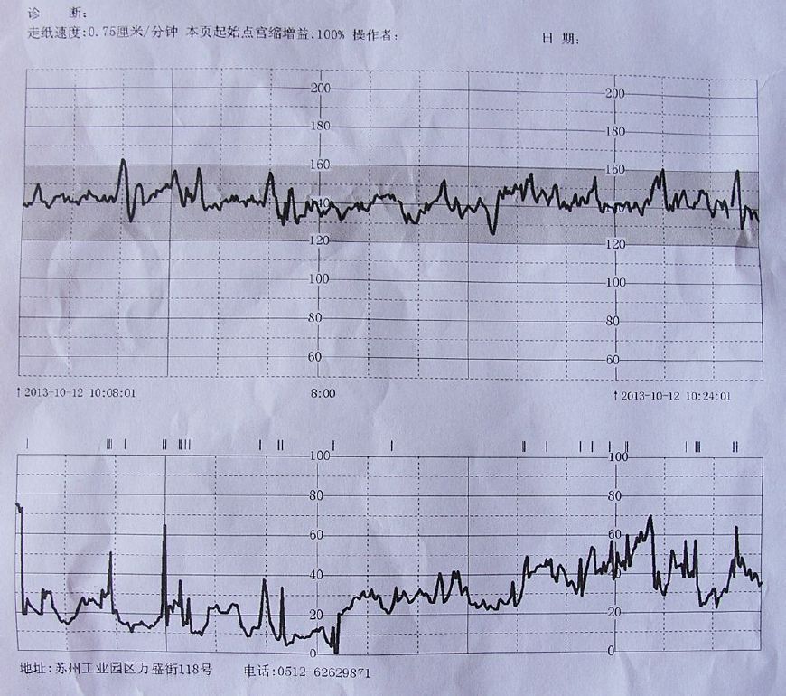 胎心监护图怎么看 胎心监测图纸怎么看