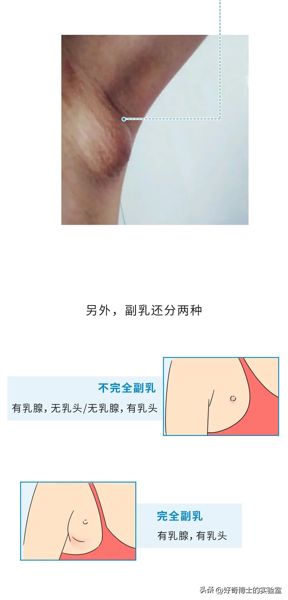 腋下淋巴结肿大 腋下有硬块凸起捏着痛