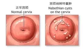 宫颈纳氏囊肿 宫颈囊肿自愈最佳方法