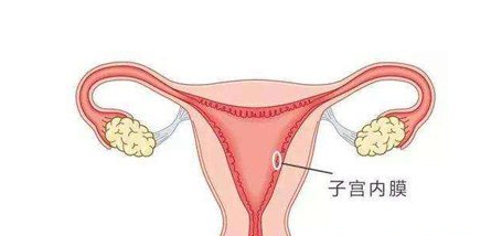 子宫内膜增生 曼月乐环