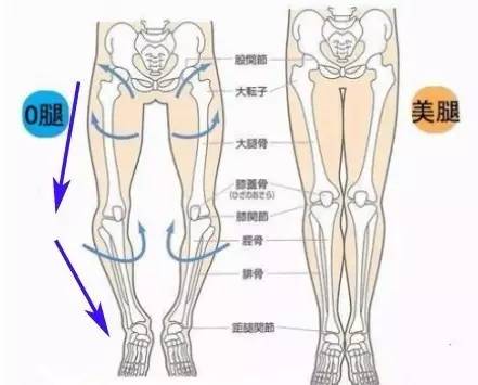 o型腿怎么矫正 正常腿和o型腿区别图
