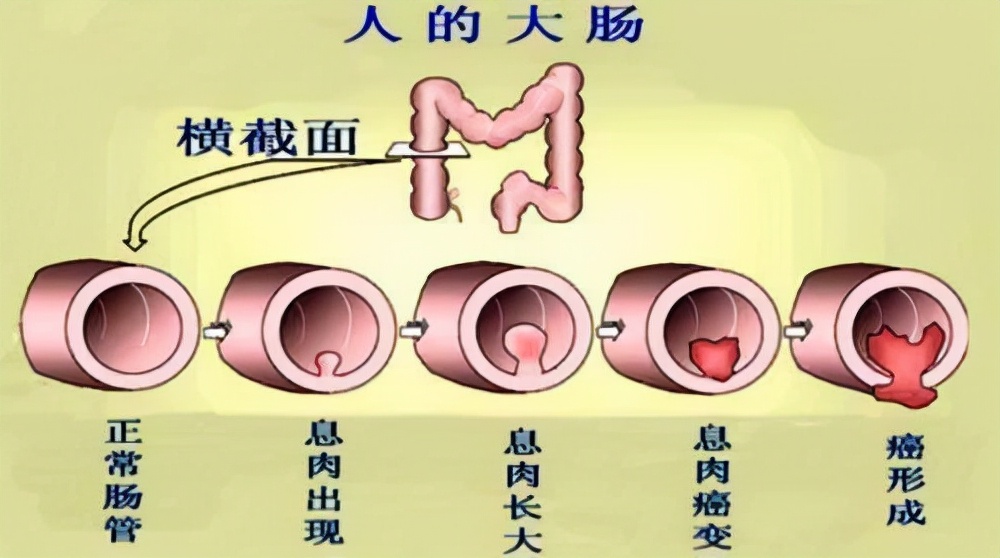 6种症状需做肠镜检查 什么症状可以做肠镜