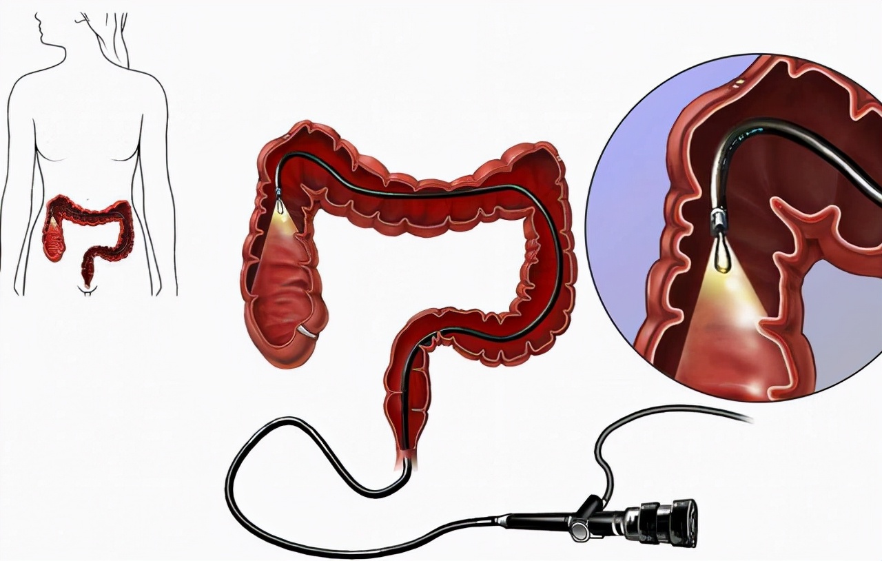 6种症状需做肠镜检查 什么症状可以做肠镜