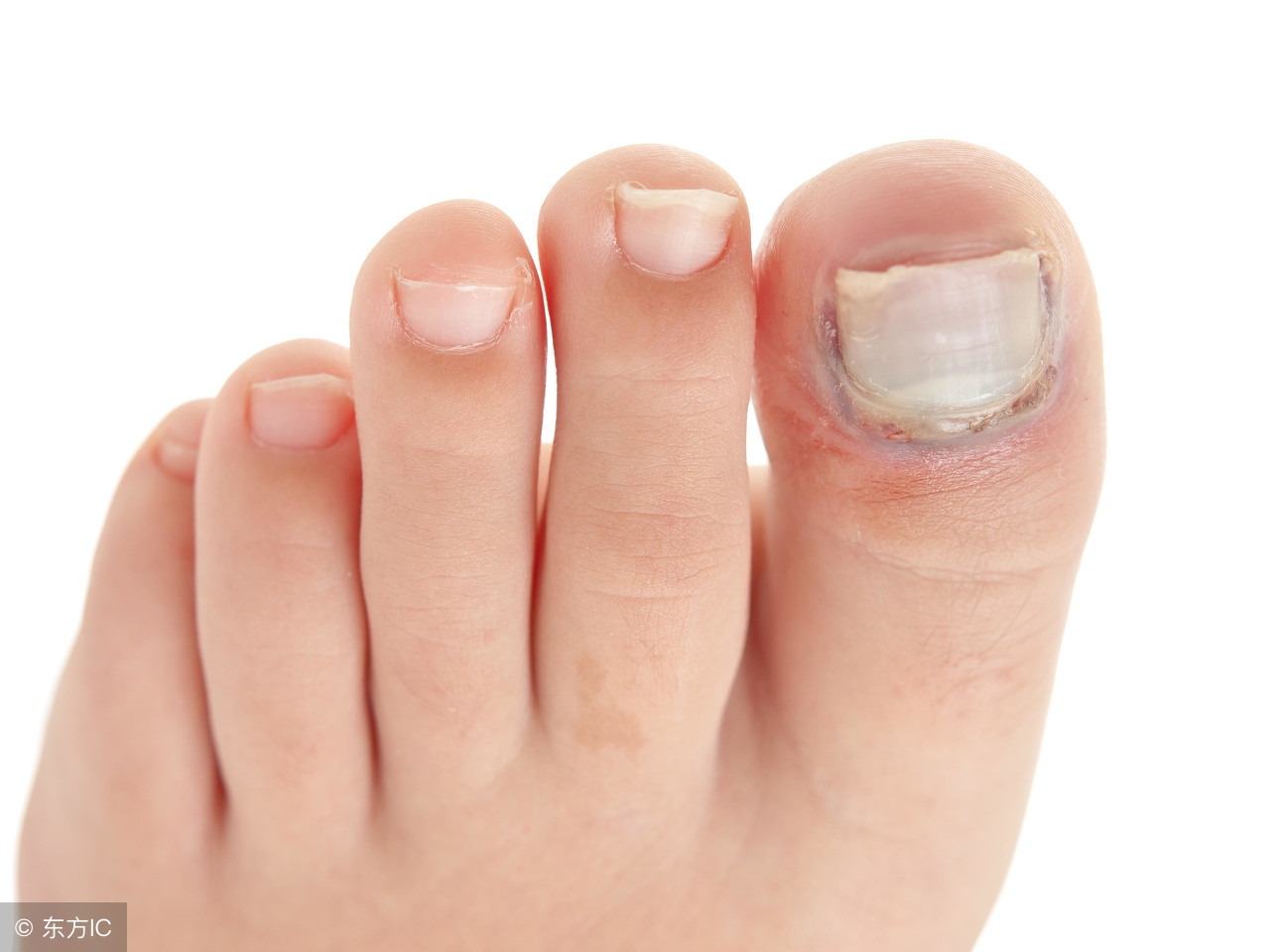 灰指甲的初期症状 怎样判断是不是灰指甲