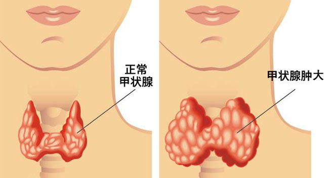 甲状腺弥漫性肿大 甲状腺肿大会自愈吗