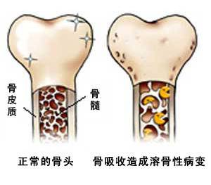 骨癌能治好吗 骨癌最怕三处痛