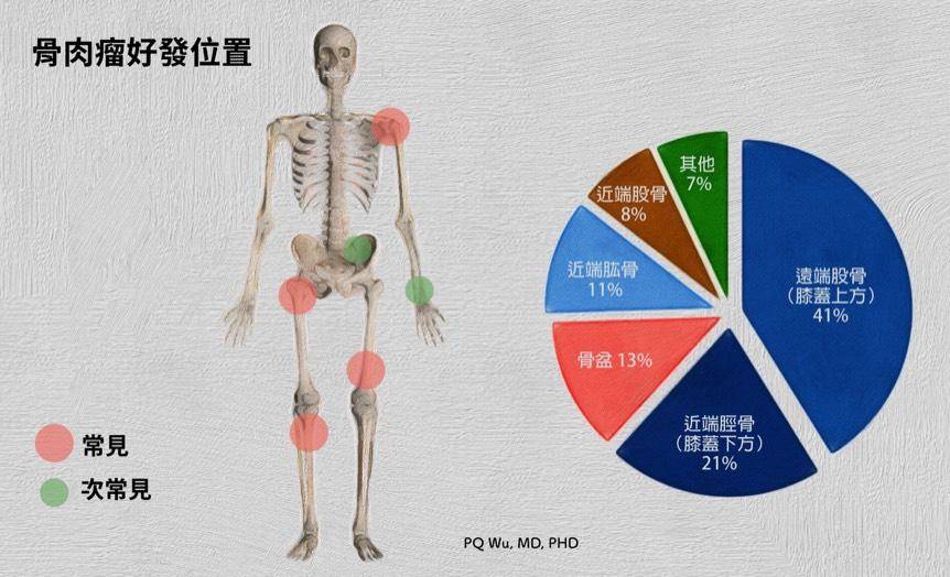 骨癌能治好吗 骨癌最怕三处痛