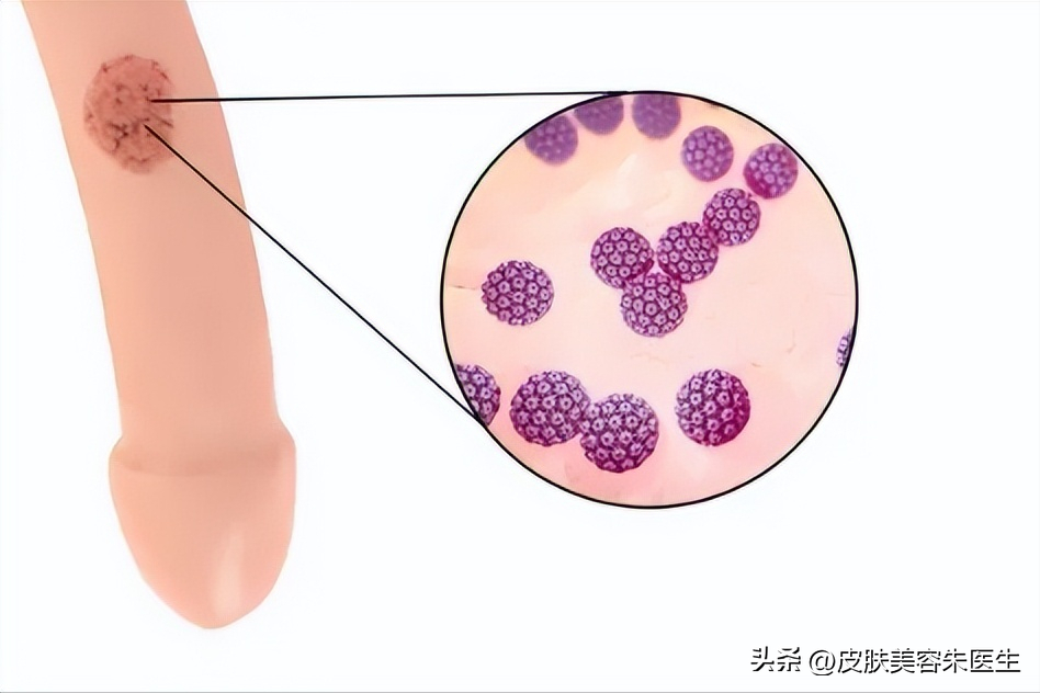 冠状沟珍珠疹 珍珠疹一周就自愈了