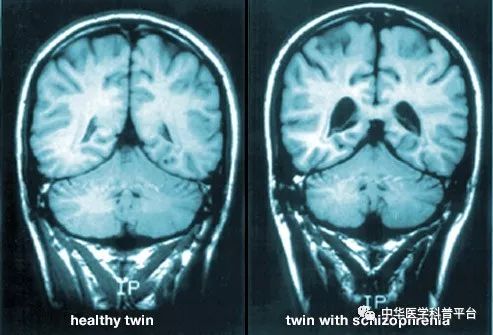 精神分裂症的症状 精神类疾病有哪些