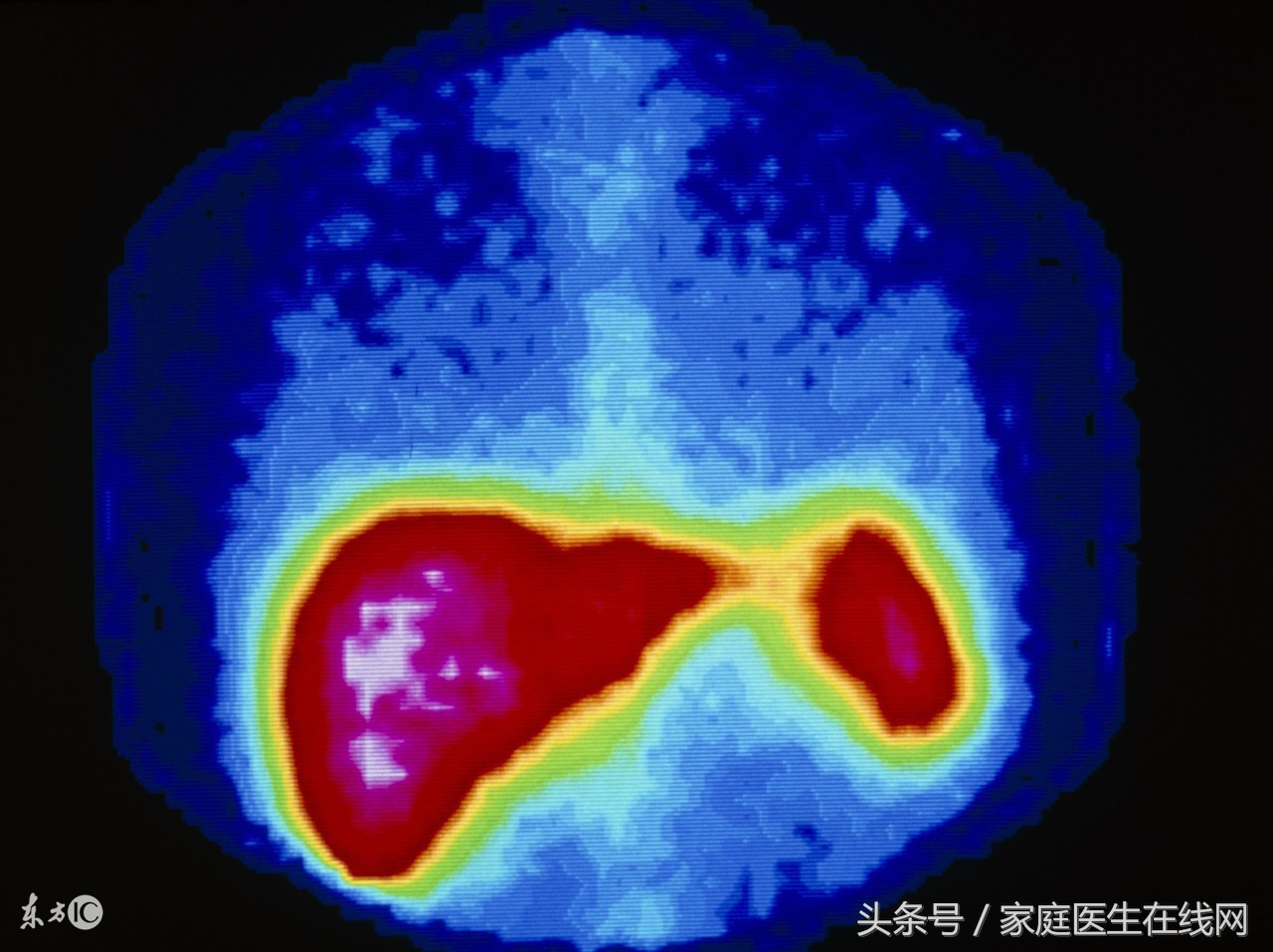 肝癌早期症状 一分钟自测肝癌