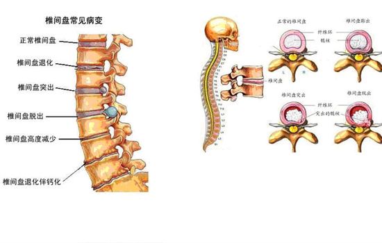 椎间盘突出症 椎间盘突出能治愈吗