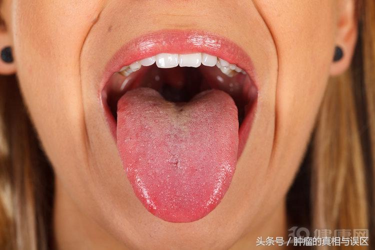 舌癌的早期症状 舌头痒是舌癌前兆
