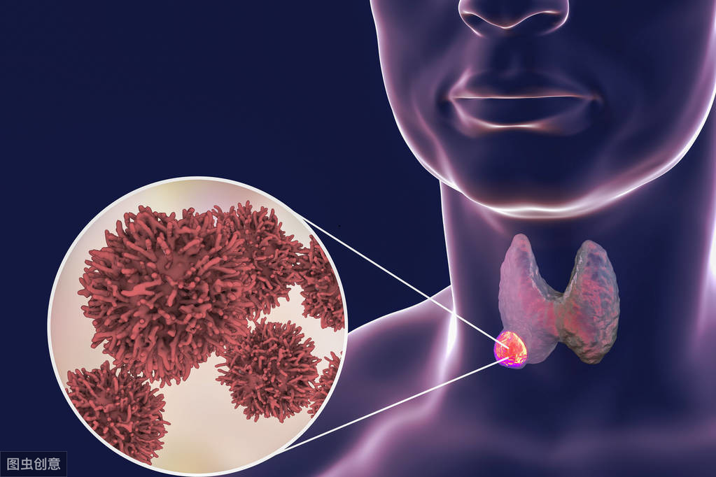甲状腺结节的危害 甲状腺结节分类