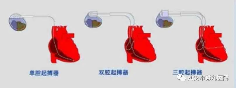 心脏起搏器价格 心脏起搏器价格8万