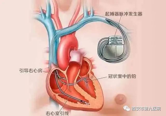 心脏起搏器价格 心脏起搏器价格8万