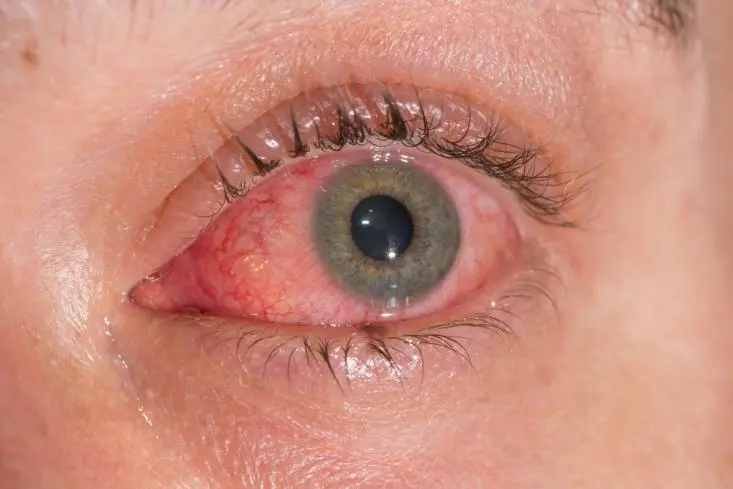 红眼病会传染吗 红眼病多久自愈