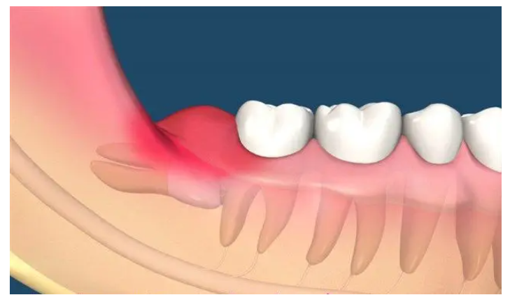 智齿发炎吃什么 智齿发炎多久才会好