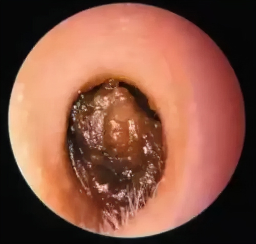 耳朵里面长了个硬包 耳朵旁边长了个硬包