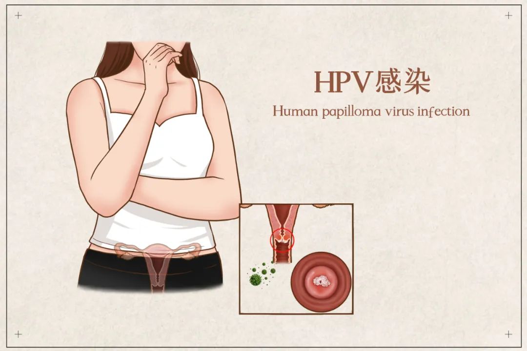 HPV是怎么感染上的 hpv是怎么造成的