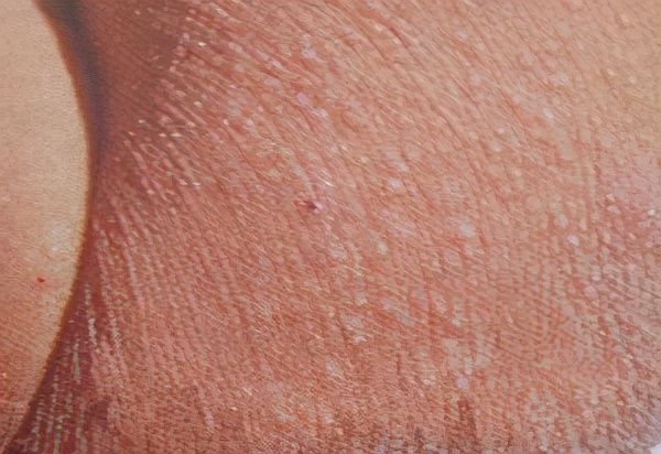 湿疹图片初期症状图片 怎么判断是螨虫痘痘