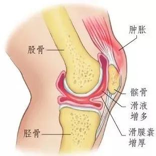 膝盖疼痛是怎么回事? 膝盖疼是痛风吗