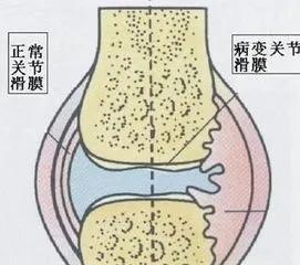 膝盖疼痛是怎么回事? 膝盖疼是痛风吗