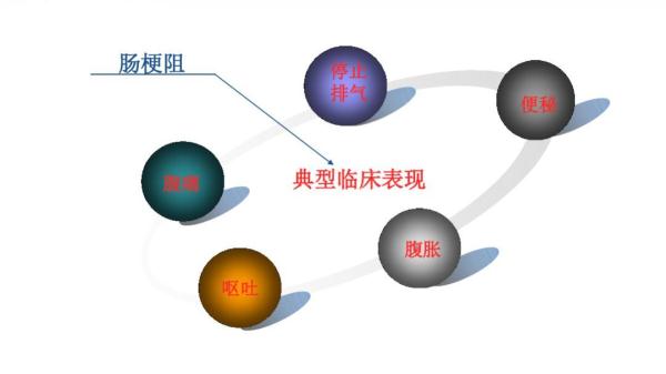 肠梗阻的症状 肠梗阻吃什么恢复快